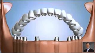 Ten Dental Implants Fixed Bridge [upl. by Aonehc]