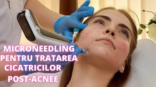 Microneedling Dermapen pentru tratarea cicatricilor postacnee  DermaBeauty Clinique [upl. by Wynnie701]