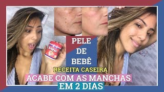 PELE DE BEBÊ EM 2 DIAS SEM MANCHAS RECEITA CASEIRA [upl. by Chevalier]