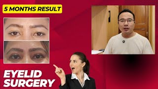 Eyelid surgery thaa 5 gi result and yet oi manadabei discussion [upl. by Lardner551]