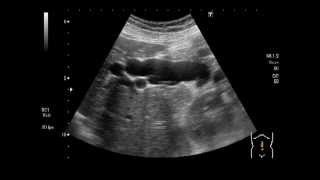 Congenital biliary dilatationmalfusion of pancreaticobiliary ducts [upl. by Amer529]