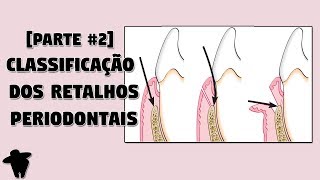 Classificação dos Retalhos Periodontais e Incisões Periodontais  Aula de Cirurgia Periodontal [upl. by Kamaria]