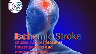 Ischemic Stroke Davidson medicine lectureosmosis selflessmedicose [upl. by Cherlyn]