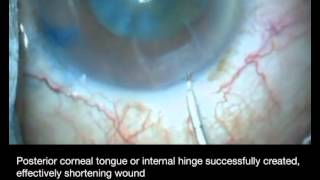 Shortening a Long Clear Corneal Incision [upl. by Ettennan]