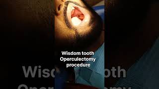 Wisdom tooth treatment  Operculectomy  Wisdom teeth surgery Wisdom tooth removal proceduredental [upl. by Sevein339]