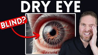 6 Ways Dry Eyes Can Affect Your Eyes And Vision Can You Go Blind [upl. by Davine]