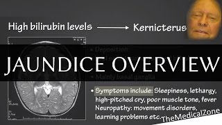 Jaundice Overview  Definition and Pathology Including neonatal jaundice [upl. by Tamis]