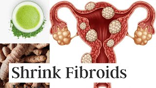 3 Ways to Shrink Fibroids Naturally Without Surgery [upl. by Miun]