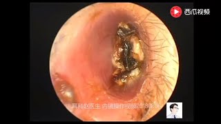 Treatment of external auditory canal cholesteatoma without anesthesia for 11 minutes [upl. by Buhler]