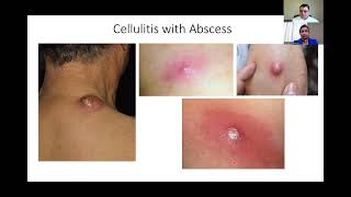 Diagnosis and Treatment of Cellulitis [upl. by Scheider277]