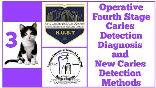 Operative  Fourth Stage  Caries Detection  Diagnosis amp New Caries Detection Methods [upl. by Rikahs217]