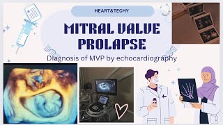 MITRAL VALVE PROLAPSE [upl. by Horwitz105]