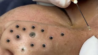 Big Cystic Acne Blackheads Extraction Blackheads amp Milia Whiteheads Removal Pimple Popping  3717 [upl. by Sailesh784]