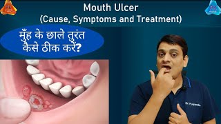 Mouth Ulcer  Treatment for Immediate Relief By Dr Puspendra [upl. by Asha]