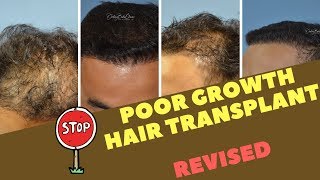 Reason for POOR GROWTH after a Hair Transplant amp Revision [upl. by Durstin]