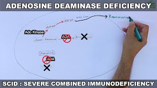 Adenosine Deaminase Deficiency  SCID [upl. by Ellevehs]