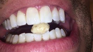 Most dangerous Tonsil stone removal [upl. by Goerke]