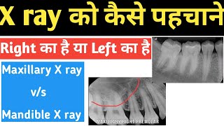 X ray को कैसे पहचाने Right का है या Left का है [upl. by Haletky]