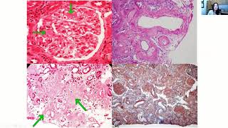 Renal Amyloidosis Presentations Diagnosis and Management [upl. by Lole766]