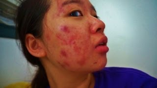 My Acne Story  18th Week of Accutane [upl. by Nageek]