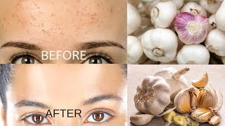 Remove Forehead Pimples Overnight  Acne Treatment with Garlic [upl. by Ranna984]