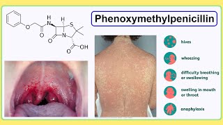 phenoxymethylpenicillin [upl. by Yelroc]