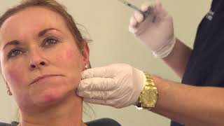 Full face filler treatment  nonsurgical volumetric facelift [upl. by Ed]