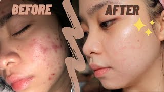 The best ANTI ACNE CREAM ✨  my holy grail  TRETINOIN [upl. by Ahoufe]