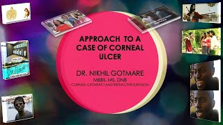 Corneal ulcer Approach to diagnosis and management Ft memes [upl. by Mettah157]