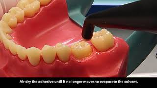 3M™ RelyX™ Ultimate Adhesive Resin Cement Application Video [upl. by Tnecniv252]