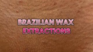 Maximizing Comfort How to Extract Ingrown Hair After a Brazilian Wax [upl. by Nekial]