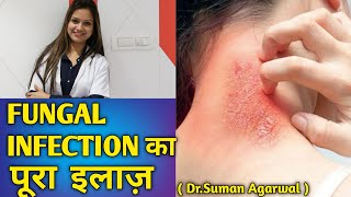 फंगल इन्फेक्शन का पूरा इलाज़  fungal infections by dermatologist Dr Suman Agarwal [upl. by Annel]