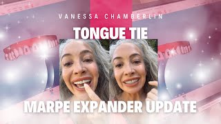 Tongue Tie amp Marpe Expander Update [upl. by Kata]