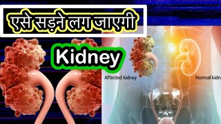 Renal Cyst Causes Signs and Symptoms Diagnosis and Treatment kidneycyst renalcyst [upl. by Hgeilyak]