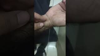 ganglion cyst at wrist [upl. by Aleinad]