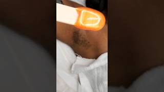 Underarm Wax Using Ahbolish Abrogate Wax SmoothResults [upl. by Atileda]