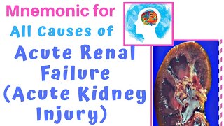 Mastering the Causes of AKI with an easy Mnemonic [upl. by Aivatnahs]