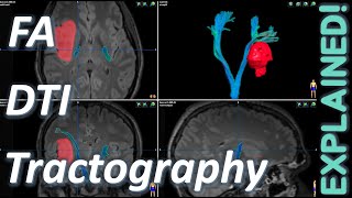 Diffusion Tensor Imaging EXPLAINED DTI FA Tractography  MRI Physics Course Lecture 15 [upl. by Epp]