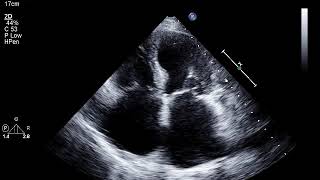 Patient with a Patent Foramen Ovale [upl. by Shult]