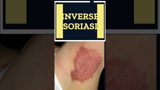 5 Types of Psoriasis You Do Not Know  Shorts [upl. by Oremor]