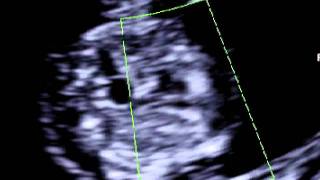 Fetal heart scan at 11 weeks of pregnancy [upl. by Lannie]