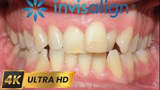 INVISALIGN treatment for 10 MONTHS 4k timelapse [upl. by Myles840]