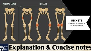 RicketsCauses amp Symptoms in hindi Pathology for medical students [upl. by Calie199]