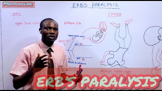 ERBS PARALYSIS MADE EASY WITH MNEMONICS [upl. by Dnalor]