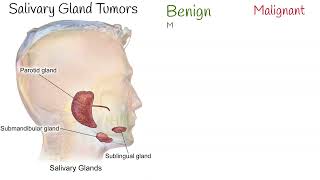 Salivary Gland Tumors Salivary gland cancers and benign tumors [upl. by Airbma]