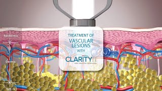 VASCULAR LESIONS TREATMENT with CLARITY II LASER PLATFORM  AVISSA SKIN  ANN ARBOR MI [upl. by Melville]