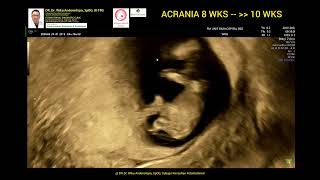 Acrania early diagnosed 8weeks  10 weeks [upl. by Kendal]