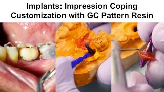 8a Implants Impression Coping Customization with GC Pattern Resin [upl. by Sarajane]