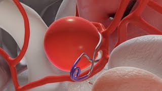 Aneurysm Clipping 3D Animation [upl. by Oiril868]