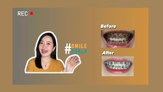 Braces Underbite  910 Months  PH Underbite [upl. by Morril]